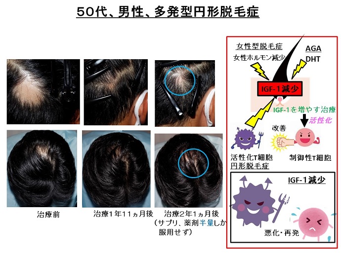 円形脱毛症　病院
